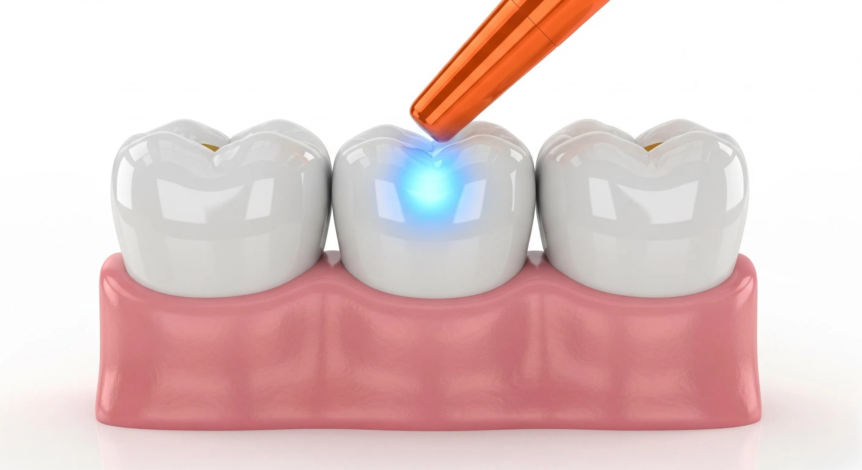 Composite Fillings Cost and Pricing Information in Bowie