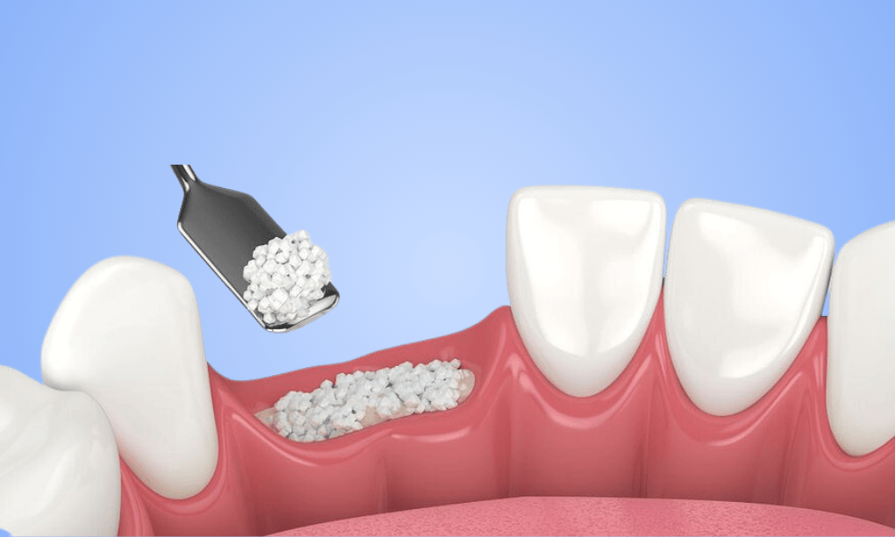 Why Choose Bone Grafting in Bowie?