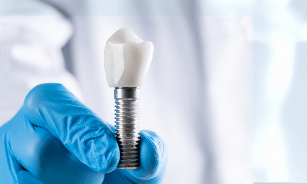 Why Choose Dentist in Bowie for Dental Implants?