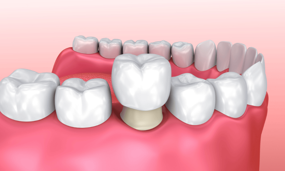 Prosthodontic Treatments