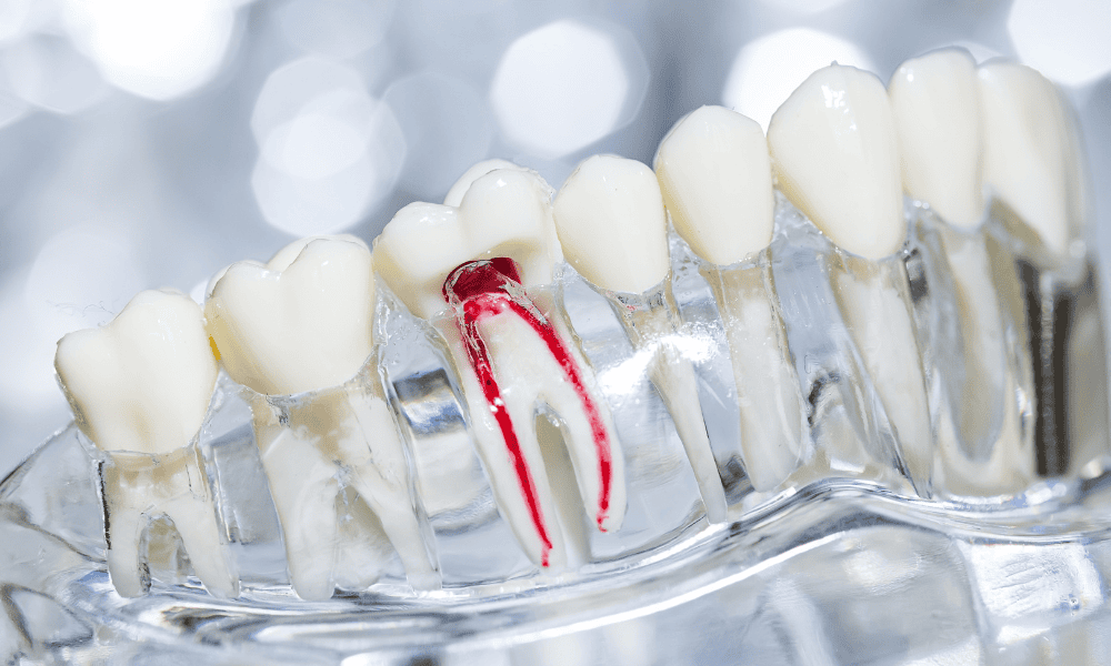 Root Canal Treatment