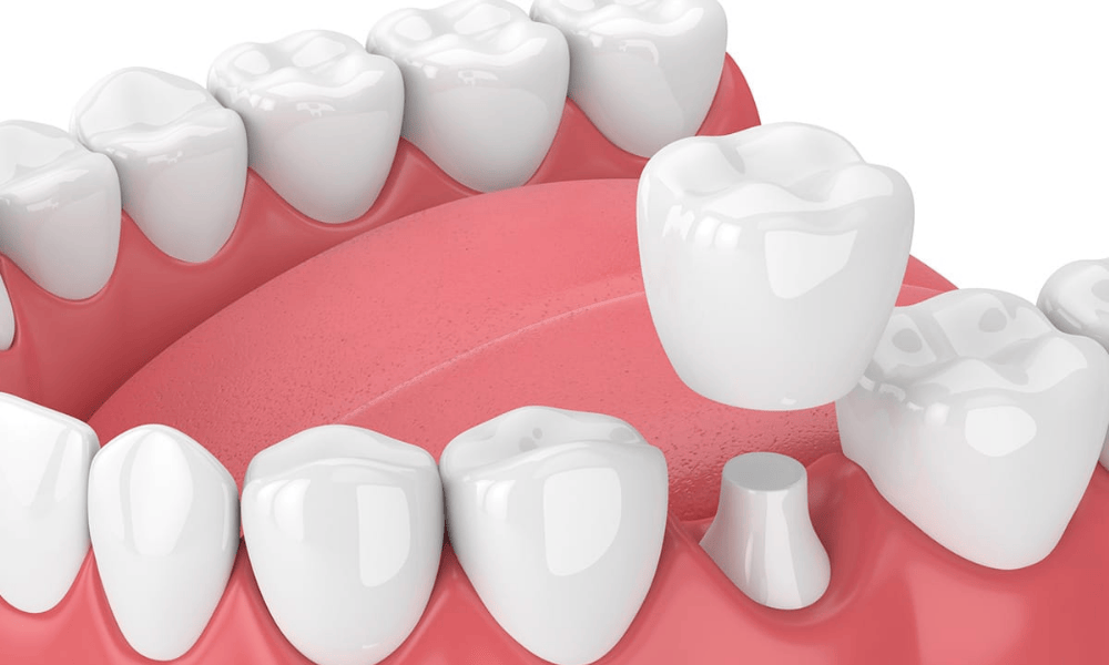 Types of Dental Crowns