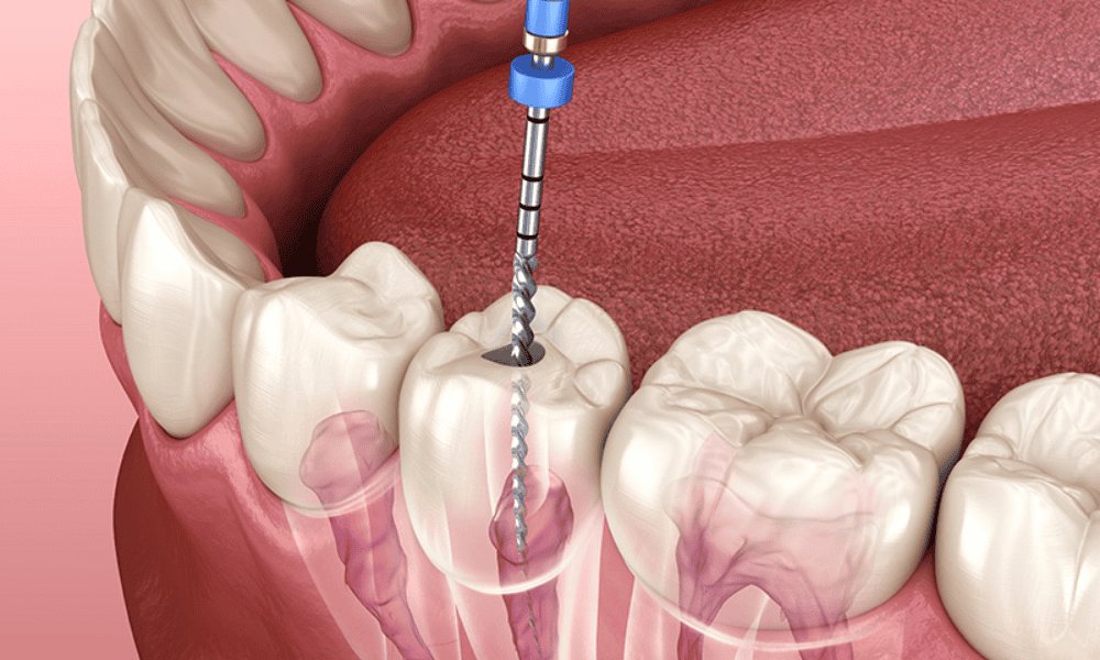 What Is a Root Canal?