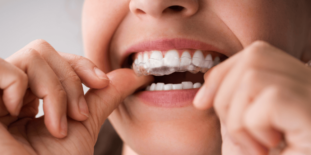 How Does Invisalign Work?