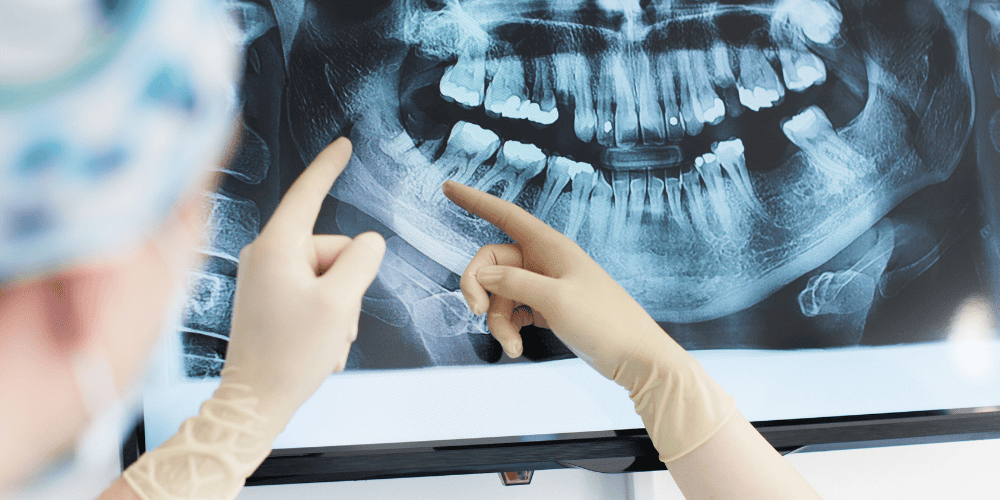 Tooth Extraction Procedure Overview