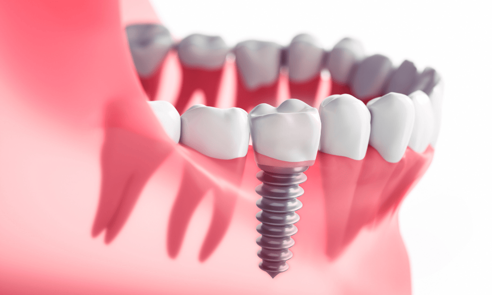 Prosthodontic Appliances