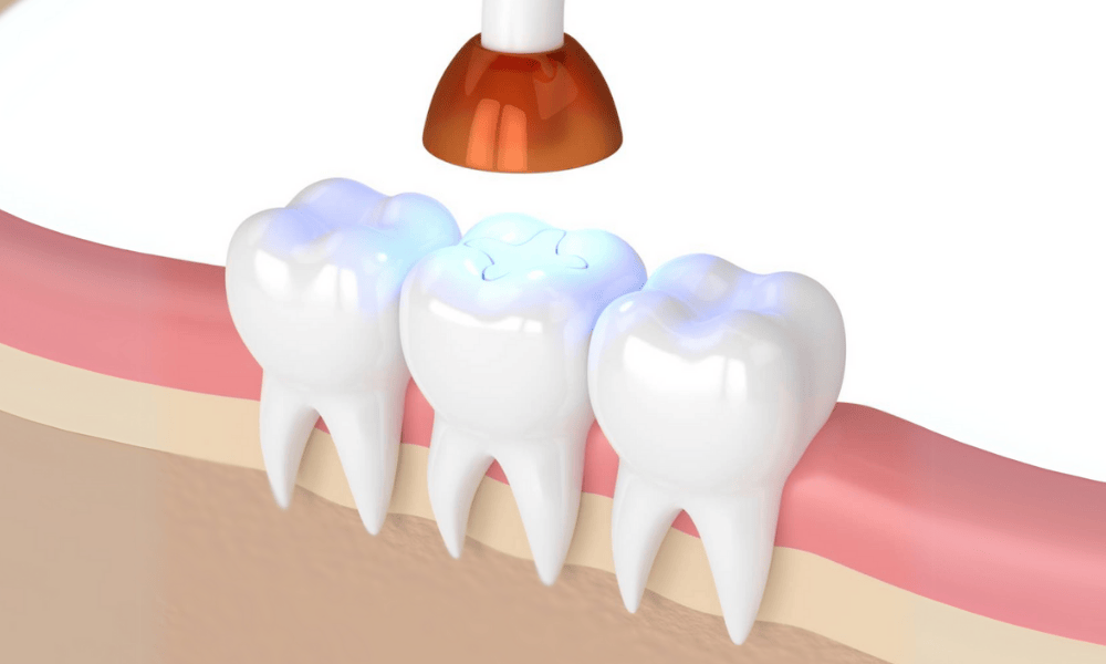 Composite Fillings Cost and Pricing Information in Bowie